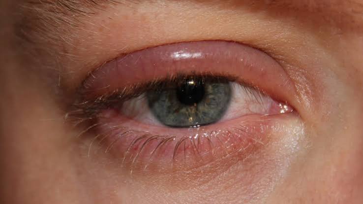 Blefaritis