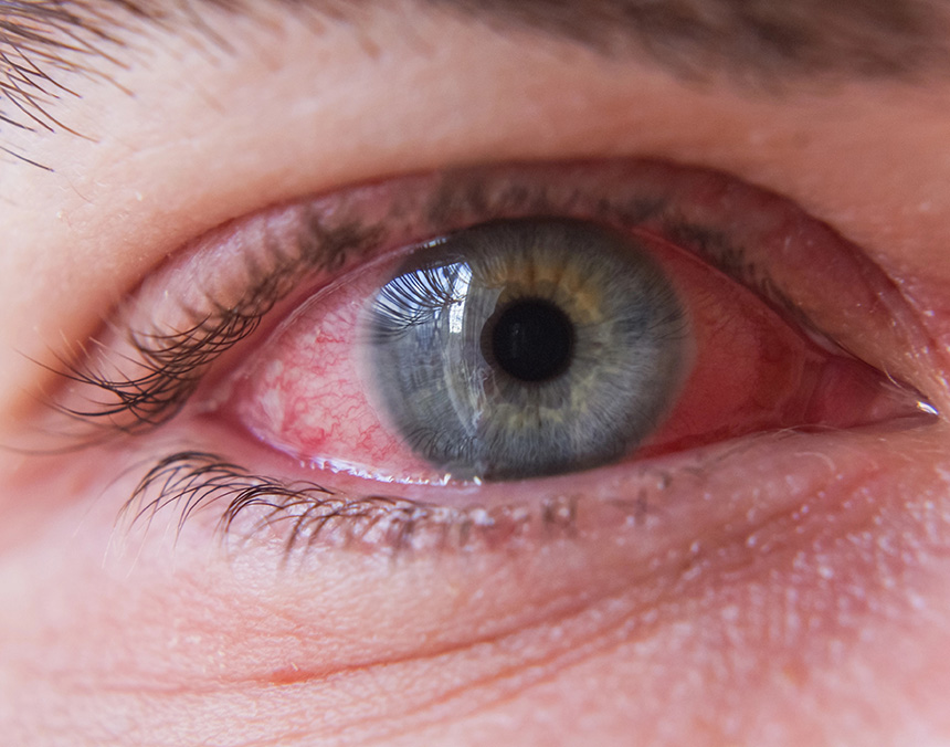 Conjuntivitis