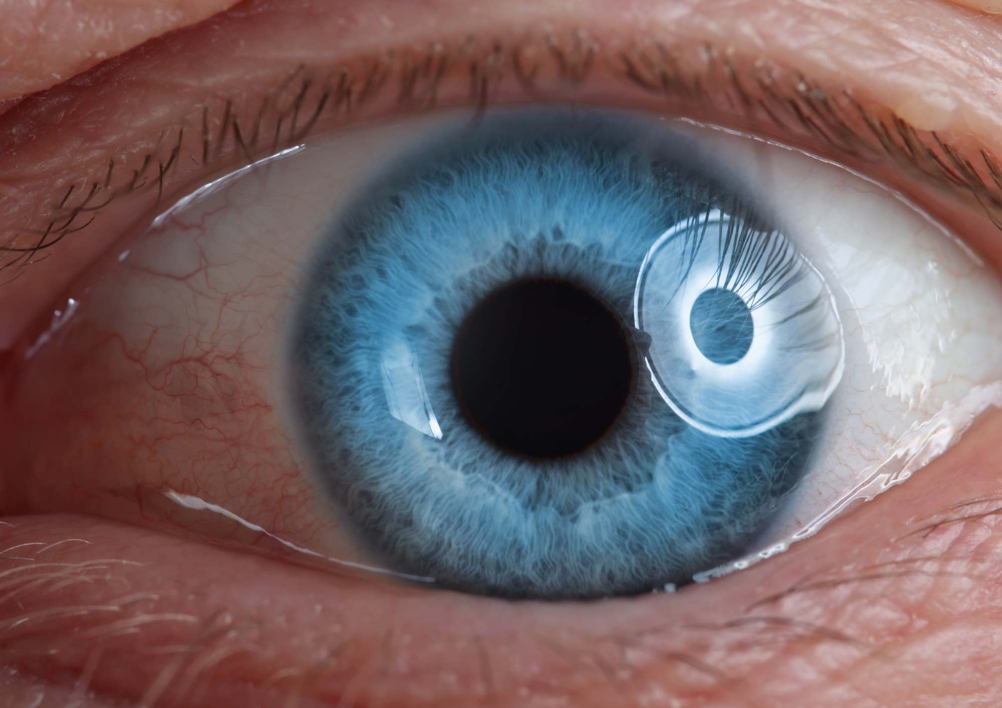 Desprendimiento de retina