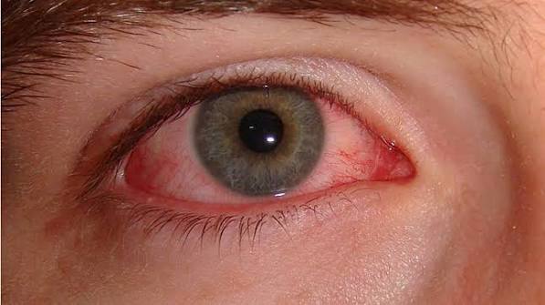 Ojo rojo: causas y urgencias