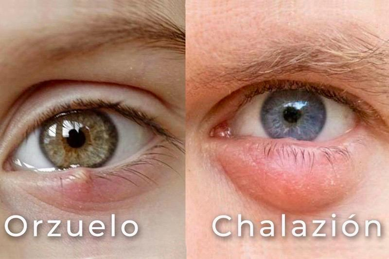 Orzuelo y chalazión