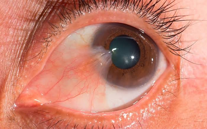 Pterigión o carnosidad en el ojo