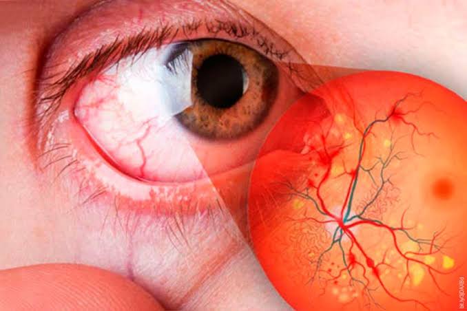 Retinopatía diabética