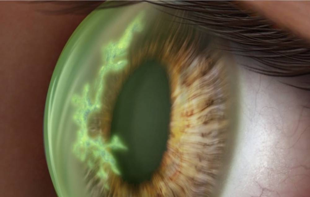 Úlcera corneal